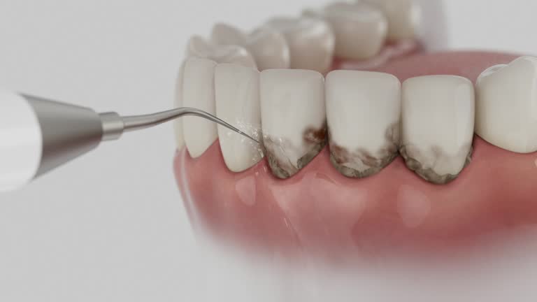 Trusted Wisdom Tooth Removal service in Fayetteville, WV - Dentist Open Now